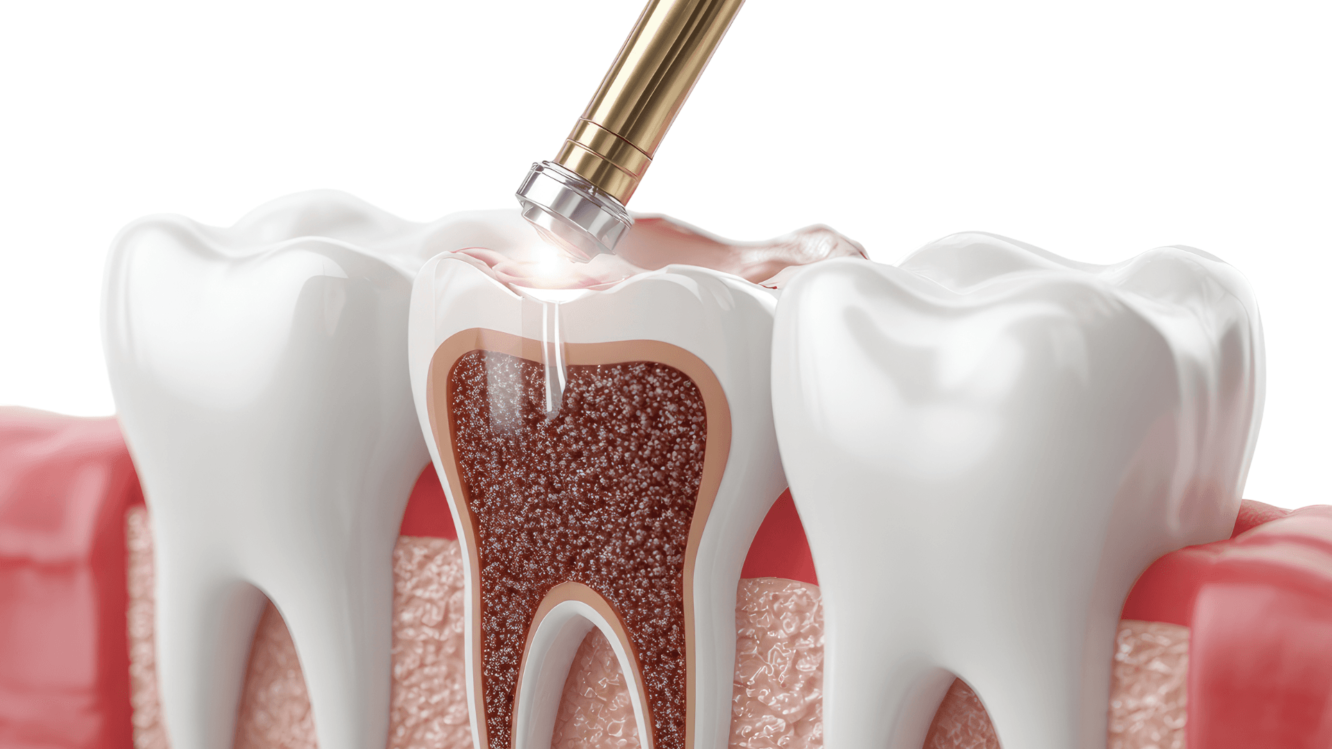 Root Canal Treatment